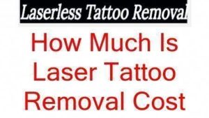 Different Tattoo Removal Methods