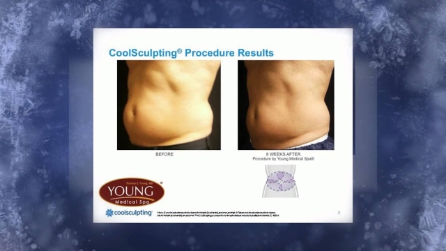 Frozen Dreams: Unveiling the Magic of Cool Sculpting