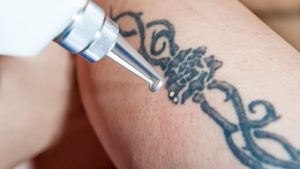 5 Techniques To Tattoo Ink Removal