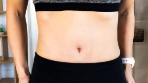 Flat and Fabulous: Unveiling the Secrets of Tummy Tucks