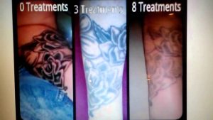 Tattoo Removal Becoming A Fad