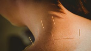 Balancing the Flow: Exploring the Ancient Art of Acupuncture